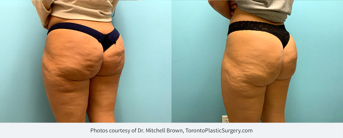 CellfinaTM Cellulite Treatment – Toronto Plastic Surgery