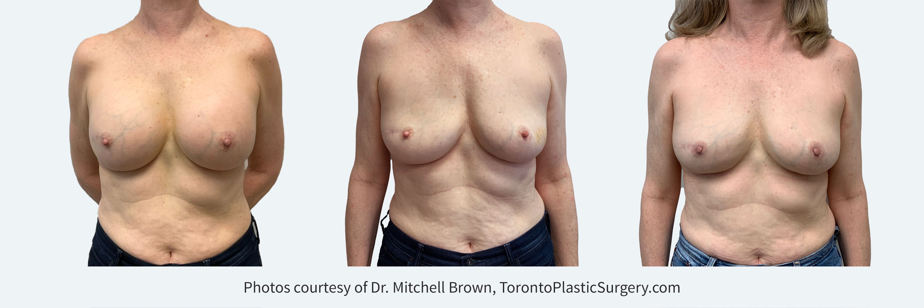 Implant Removal – Toronto Plastic Surgery