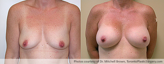 Shaped Gel Implants, Subpectoral, Fold Incision: Medium height, Full Projection – 295 gms, Before and After 8 Years