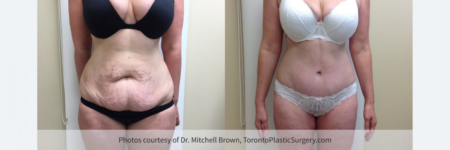 Tummy Tuck – Toronto Plastic Surgery