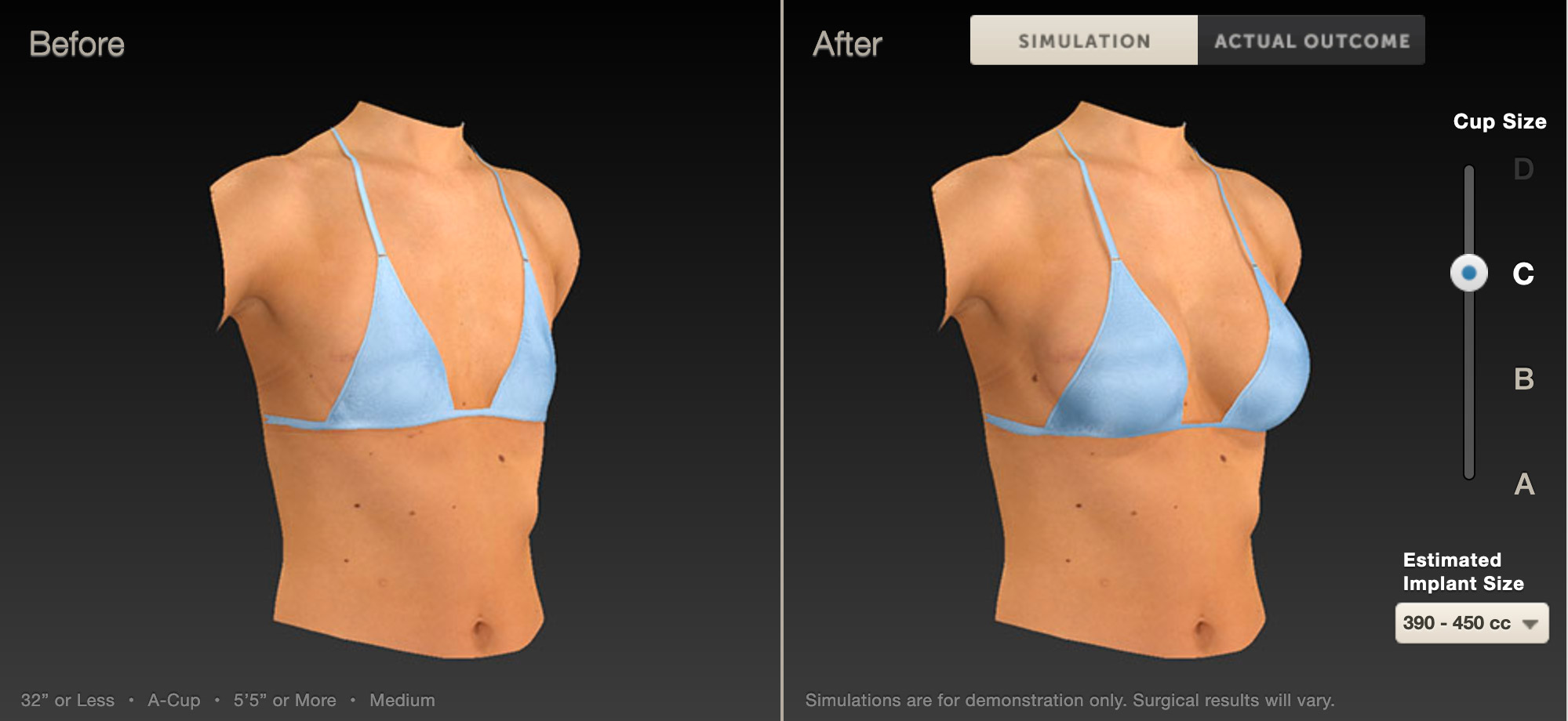 Breast Augmentation- A to a C Cup Before and After